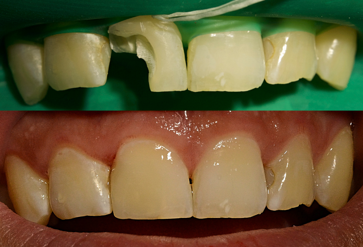 Реставрация зубов: когда необходима и как проводится?