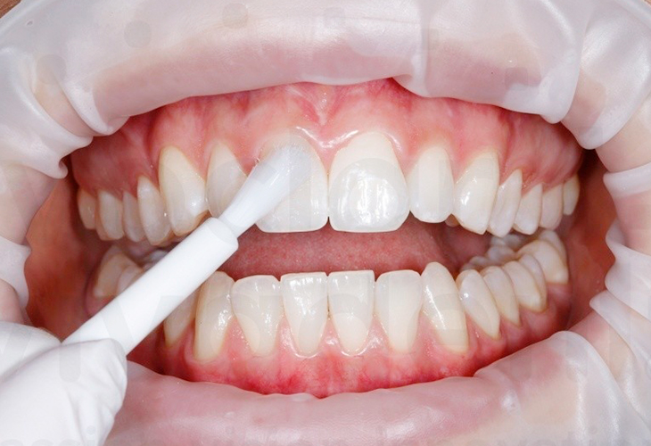 Что такое реминерализация зубной эмали и когда она необходима