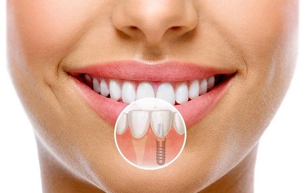 Как проводится имплантация зубов?