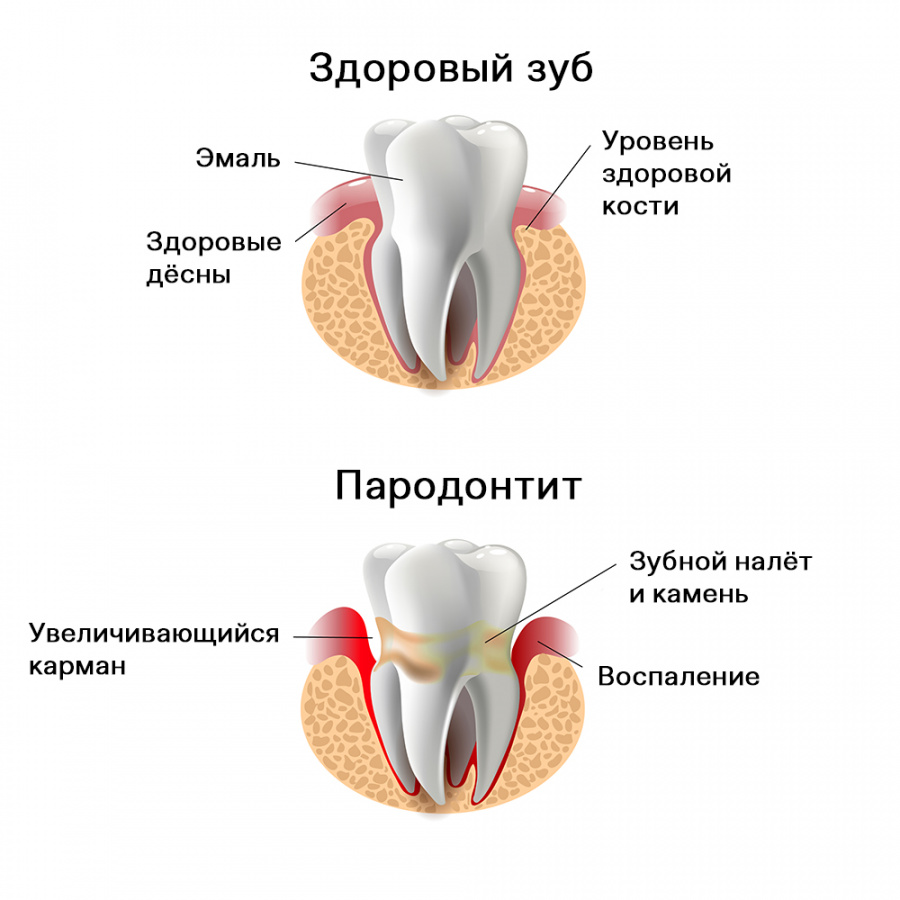 Сравнение здорового зуба и зуба при пародонтите