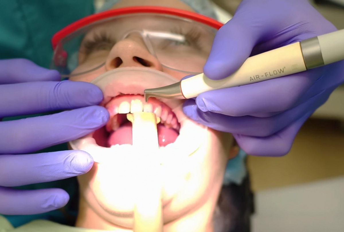Как проводится отбеливание зубов методом Air Flow